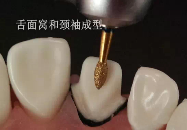 标准前牙美学牙体制备操作流程-您规范了吗？