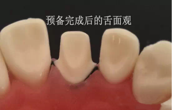 标准前牙美学牙体制备操作流程-您规范了吗？