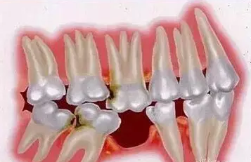 牙科小知识丨缺牙五大危害