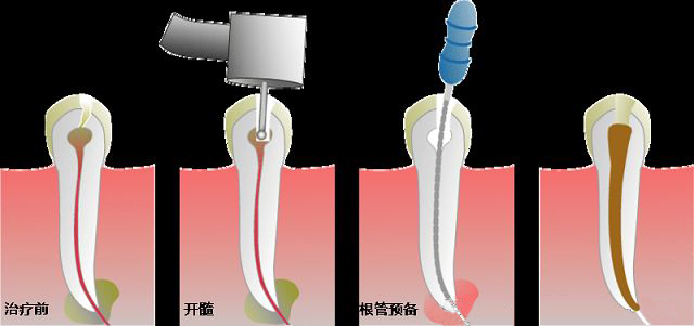关于牙齿根管治疗